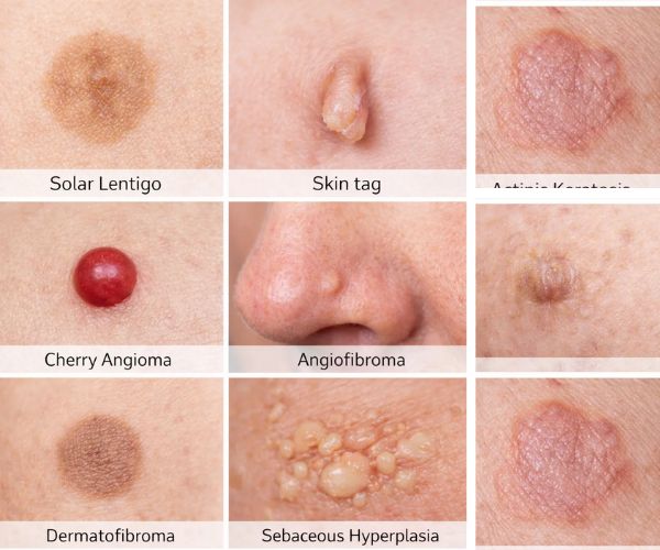 Skin conditions reference chart showing Solar Lentigo, Skin Tags, Cherry Angioma, Angiofibroma, Dermatofibroma, Sebaceous Hyperplasia, Seborrhoeic Keratosis and Actinic Keratosis